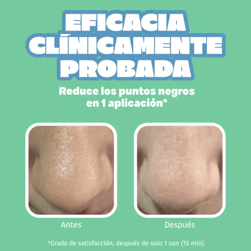IROHA NATURE Pásiky na nos BYE BYE Dirty Pores – Hĺbkové čistenie (5 ks)